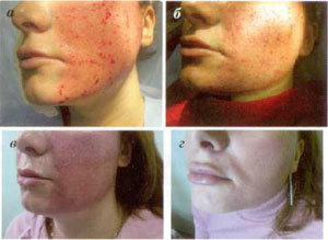 שלבים של שיקום העור לאחר הליך אבלציה חלקי
