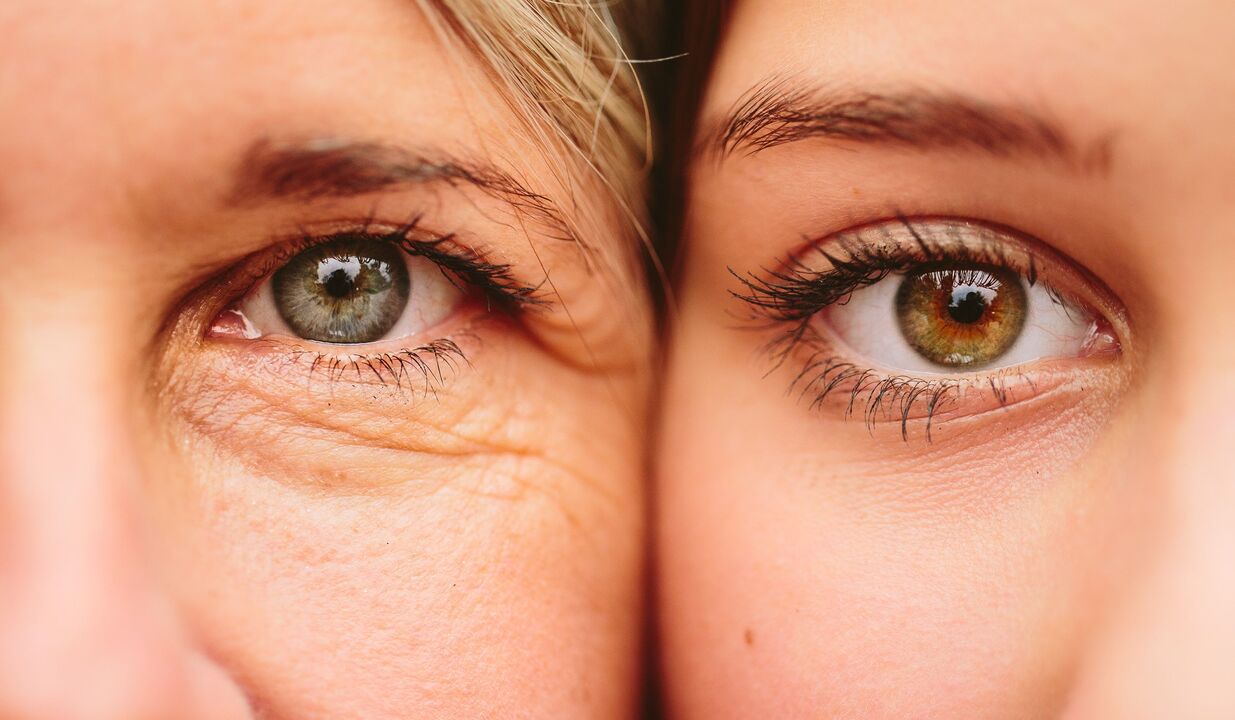סימני הזדקנות סביב העיניים